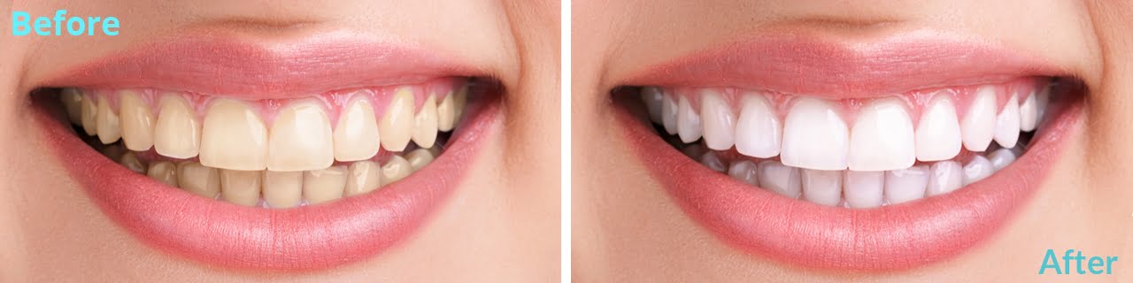 Teeth Whitening