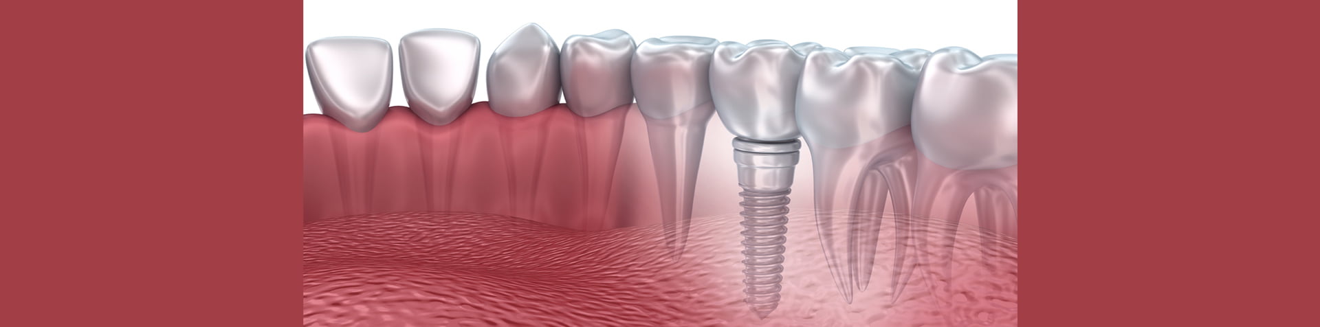 Implants