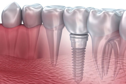 implants-blog