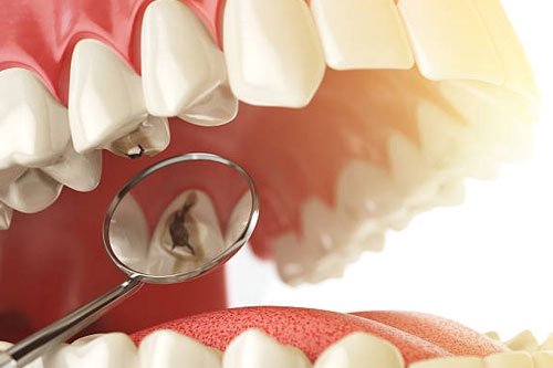 The Hole Truth: Is That Cavity a Big Deal?
